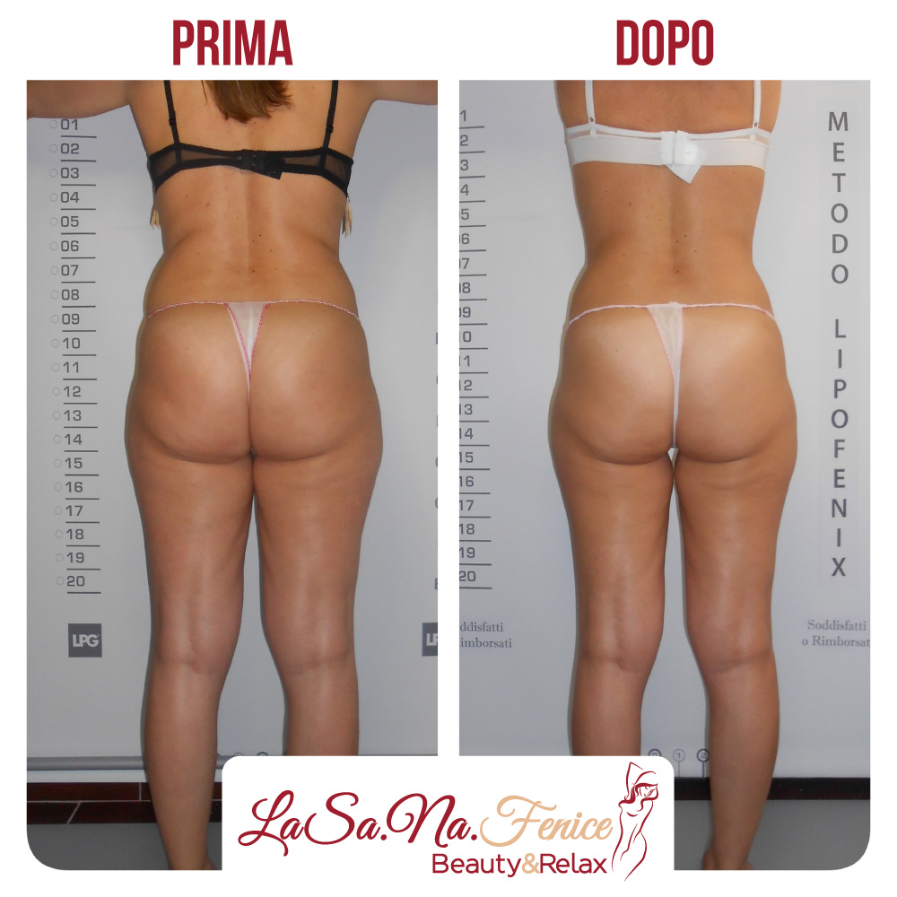 cellulite glutei rimedi