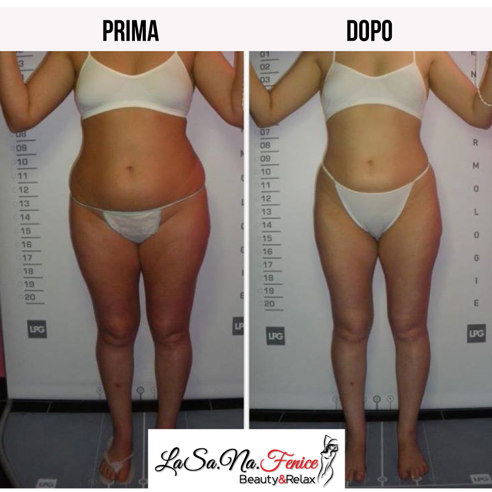 lpg-endermologie (3)