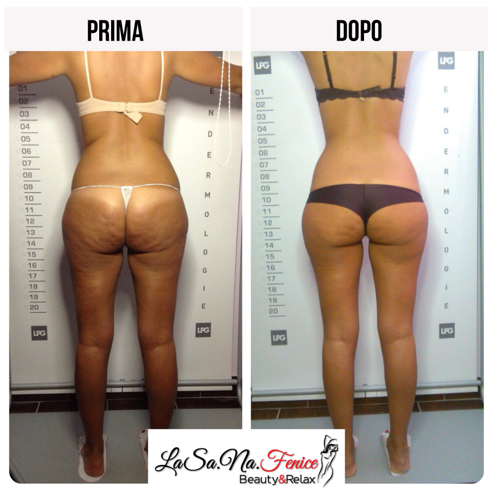 trattamenti per la cellulite